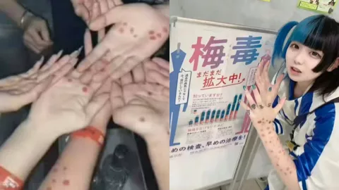 日本梅毒感染