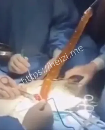 致死曝光
