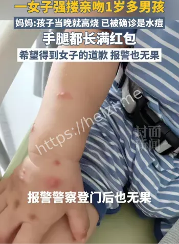 艾滋病