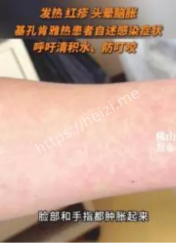 基孔肯雅热