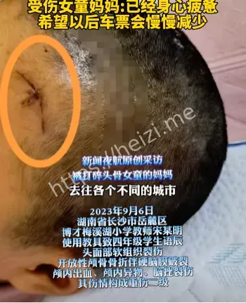 颅骨骨折
