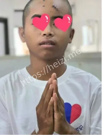 儿童头部气枪子弹取出