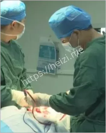 儿童头部气枪子弹取出